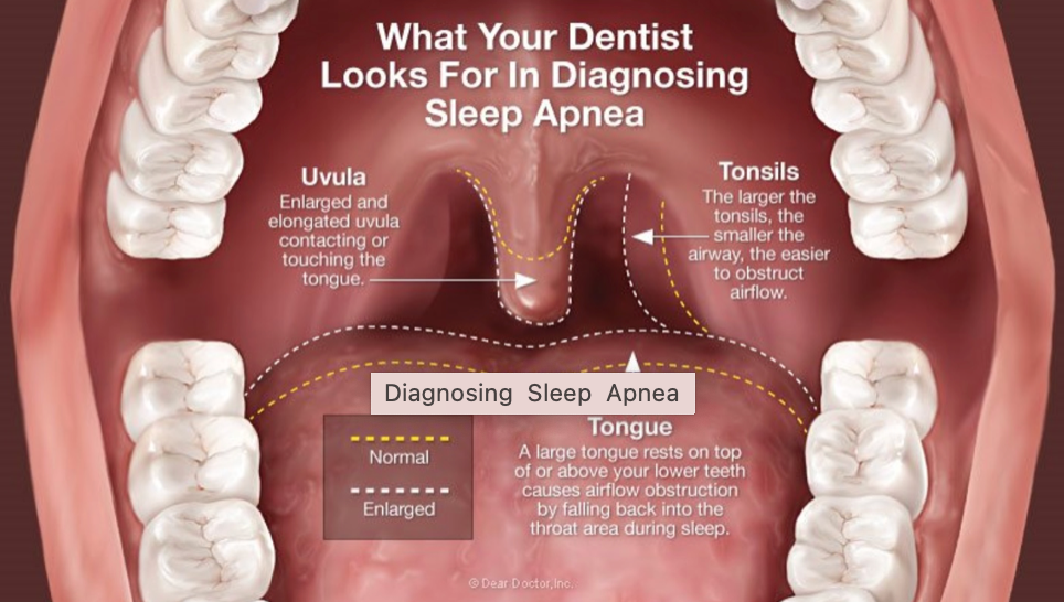 Diagnosing & Treating Obstructive Sleep Apnea, Boulder Dentist, Family &  Cosmetic Dentistry